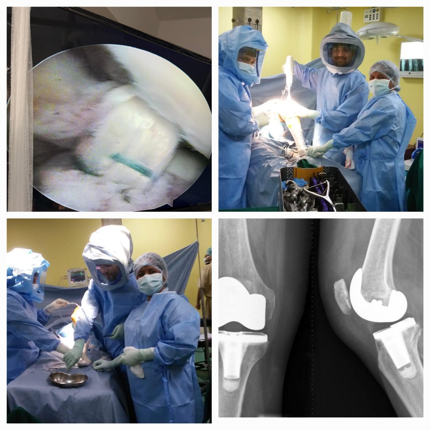 TOTAL KNEE REPLACEMENT : KNEE ARTHROPLASTY